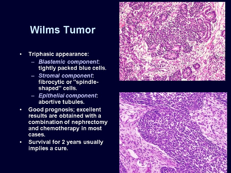 Wilms Tumor Triphasic appearance: Blastemic component: tightly packed blue cells. Stromal component: fibrocytic or